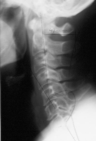 Radiographie de profil de la colonne cervicale